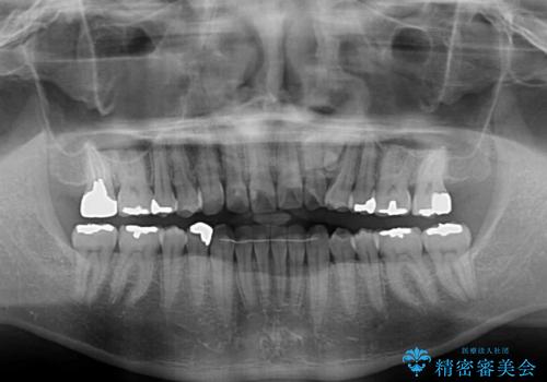 欠損のある歯列　インビザラインで整った歯並びにの治療後