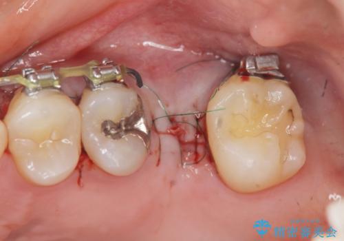 他院での矯正治療中 ソケットリフトを伴うインプラント治療依頼の治療中