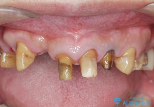 歯周病治療を伴う前歯審美セラミック治療の治療前