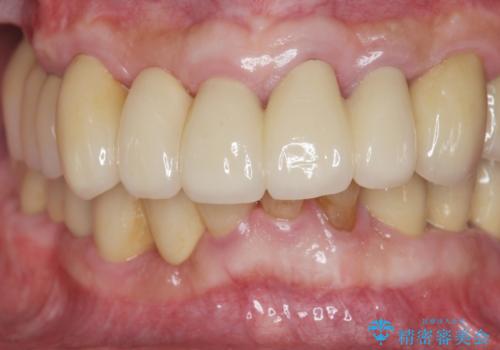 歯周病治療を伴う前歯審美セラミック治療の治療後