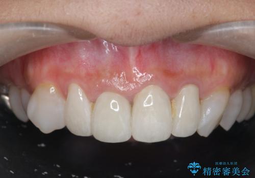 [ 前歯のセラミック治療 ]   前歯を自然にしたいの症例 治療後