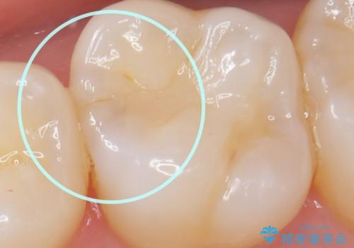 虫歯の発生を初期段階で発見　ゴールドインレー修復の治療前