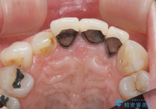[ 前歯のセラミック治療 ]   前歯を自然にしたいの治療前