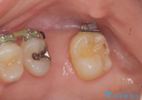 他院での矯正治療中 ソケットリフトを伴うインプラント治療依頼の治療前