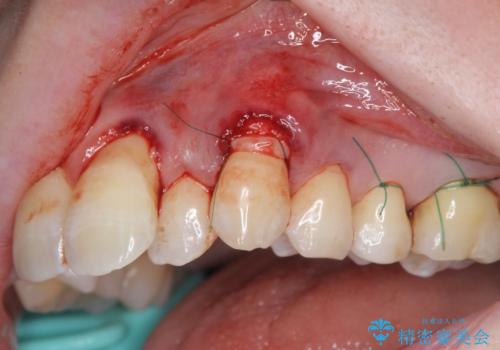 目立つ八重歯の歯ぐきのさがり 根面被覆による改善の治療中