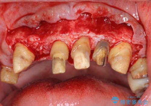 歯周病治療を伴う前歯審美セラミック治療の治療中