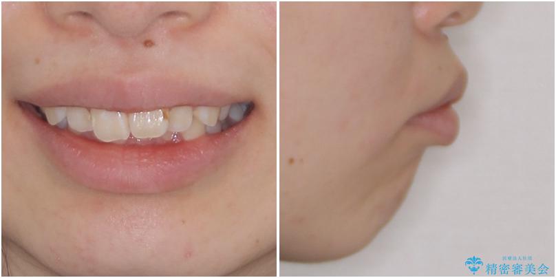上顎前突による口元の突出感　強く深い咬合をワイヤー矯正で改善していくの治療前（顔貌）