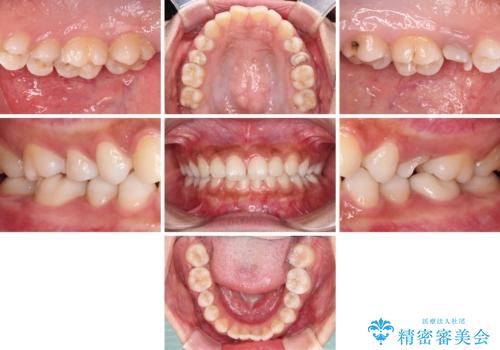 抜歯と言われた歯を残したい 部分矯正と外科処置を用いた補綴治療の治療前