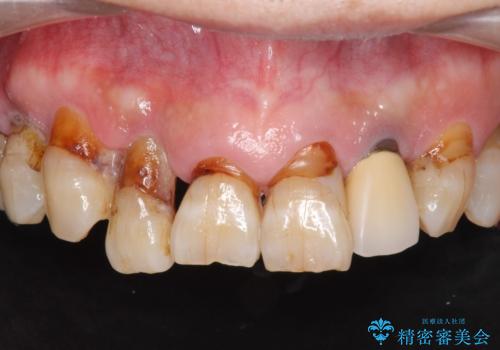 歯周病治療を伴う前歯審美セラミック治療の症例 治療前
