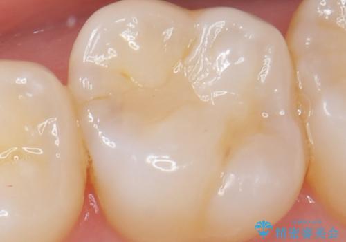 虫歯の発生を初期段階で発見　ゴールドインレー修復の症例 治療前