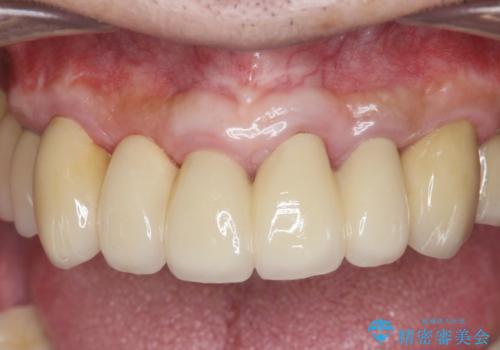 歯周病治療を伴う前歯審美セラミック治療の治療後