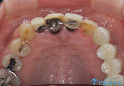ぐらつく前歯 ブリッジ治療の治療前