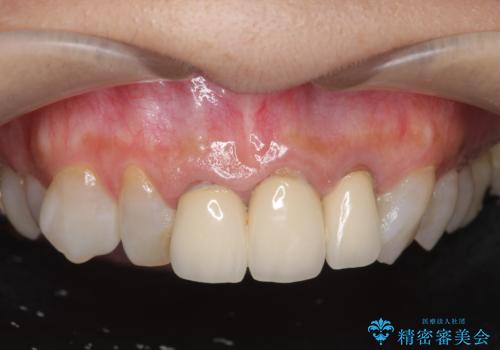 [ 前歯のセラミック治療 ]   前歯を自然にしたいの症例 治療前