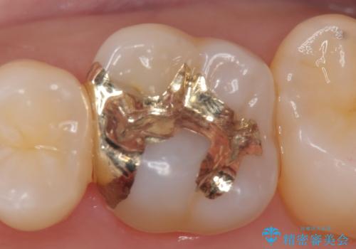 虫歯の発生を初期段階で発見　ゴールドインレー修復の症例 治療後