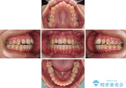 【モニター】カリエールディスタライザーとインビザラインを用いた奥歯の咬み合わせ改善の治療中