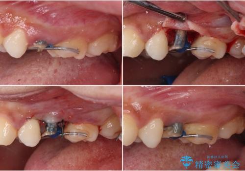 抜歯と言われた歯を残したい 部分矯正と外科処置を用いた補綴治療の治療中