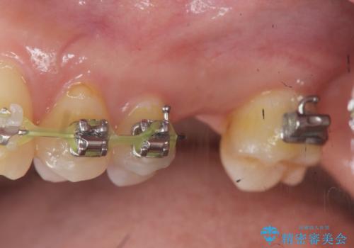 他院での矯正治療中 ソケットリフトを伴うインプラント治療依頼の症例 治療前