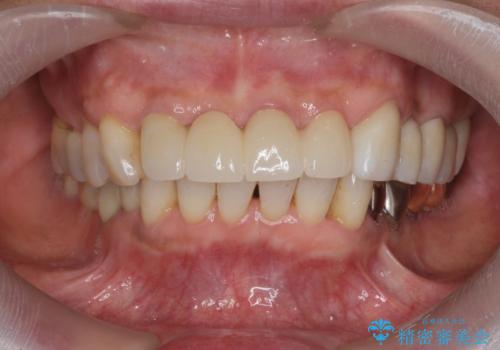 ぐらつく前歯 ブリッジ治療の治療後