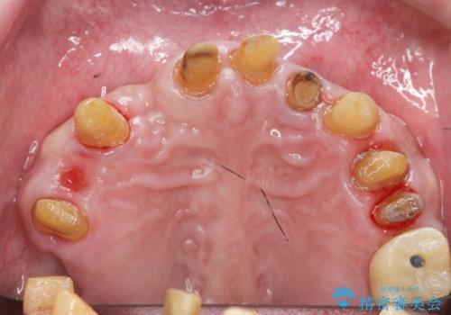 歯周病治療を伴う前歯審美セラミック治療の治療前