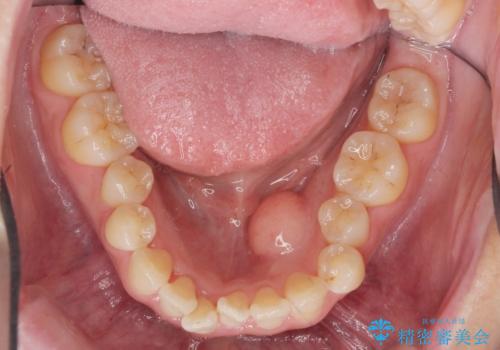 [ 下顎骨隆起の切除 ] 舌のスペースが狭く話しづらいの治療後