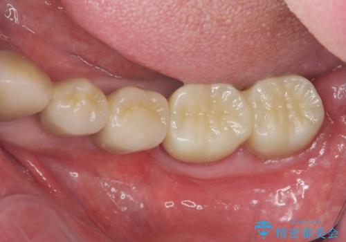 [ 歯周病治療 ]　小矯正を含むインプラント補綴・歯周補綴の治療後
