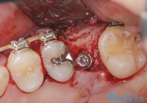 他院での矯正治療中 ソケットリフトを伴うインプラント治療依頼の治療中