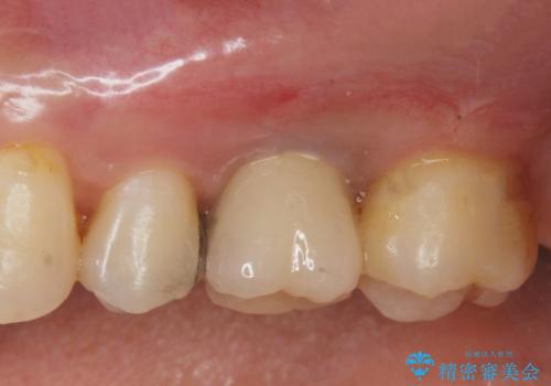 他院での矯正治療中 ソケットリフトを伴うインプラント治療依頼の症例 治療後