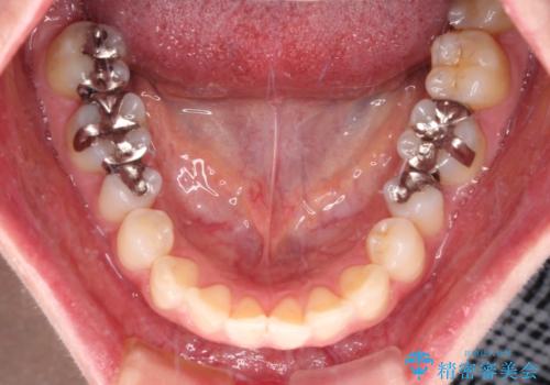 銀歯をセラミックにしたい セラミックインレー修復の治療前