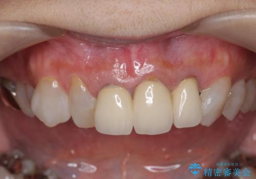 [ 前歯のセラミック治療 ]   前歯を自然にしたいの治療前
