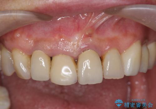 ぐらつく前歯 ブリッジ治療の治療前