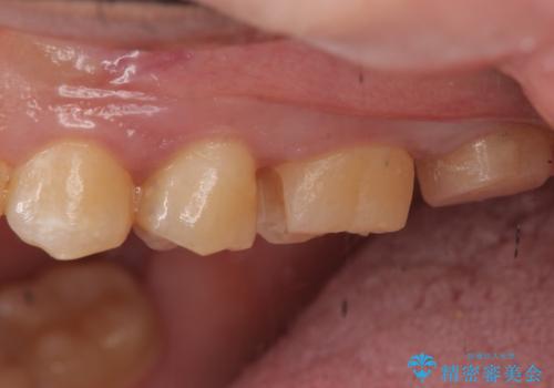 奥歯の放置した虫歯 セラミックでの治療の治療中