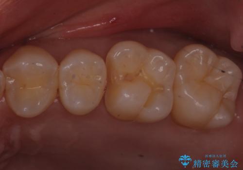 歯と歯の間の虫歯　ゴールドインレーでの修復の治療中
