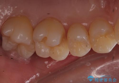 歯と歯の間の虫歯 ゴールドインレーでの修復の治療中