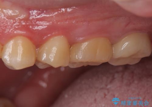 奥歯の放置した虫歯　セラミックでの治療の治療後
