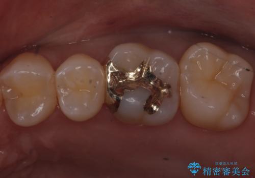 歯と歯の間の虫歯　ゴールドインレーでの修復の治療後