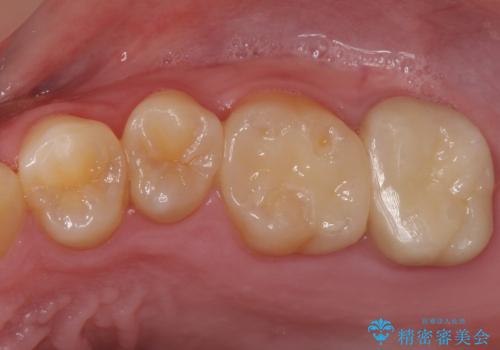 奥歯の放置した虫歯　セラミックでの治療の症例 治療後