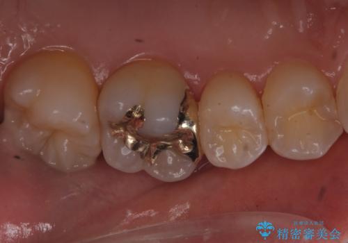 歯と歯の間の虫歯 ゴールドインレーでの修復の治療後