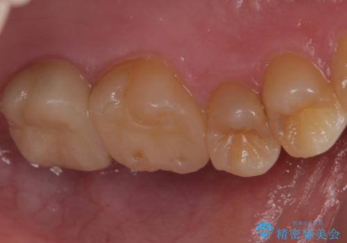 奥歯の放置した虫歯 セラミックでの治療の治療後