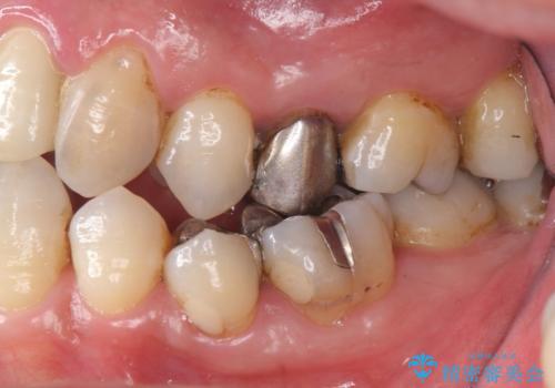 受け口 なんと部分矯正で治るんです!! インプラントを含めた総合歯科治療の治療前