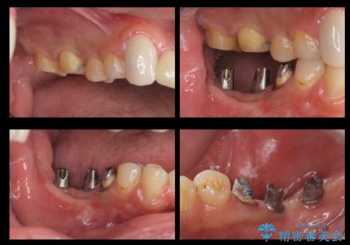 短期間で歯並びをきれいにしたい セラミックでかぶせる治療でも良いの治療中