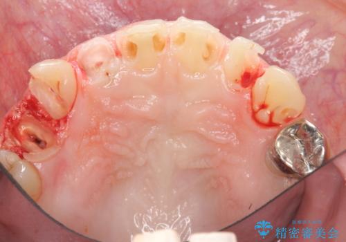 多発した前歯の重度虫歯治療の治療前