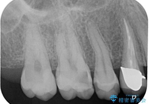 【VPT(歯髄温存療法)とセラミックインレー】深い虫歯でも神経を残したいの治療前