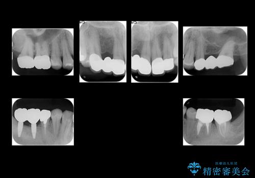 短期間で歯並びをきれいにしたい セラミックでかぶせる治療でも良いの治療後