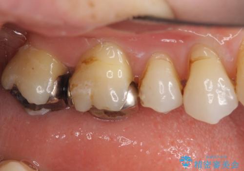 銀歯を白くしたい　セラミッククラウンでの治療の治療前