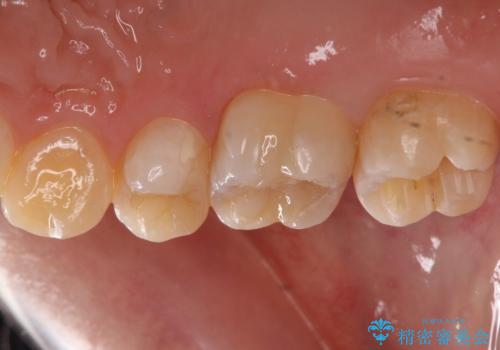 銀歯を白くしたいの治療中