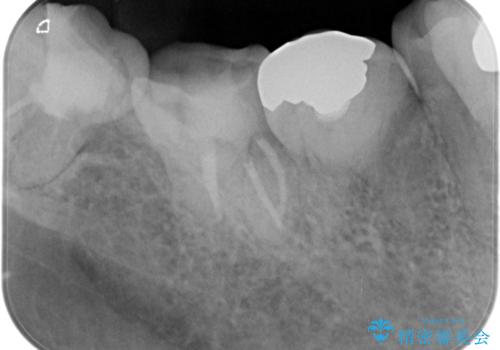 【根管治療】噛んだ時にしみる。最近になってズキズキ痛み、長引く痛みがあるの治療後