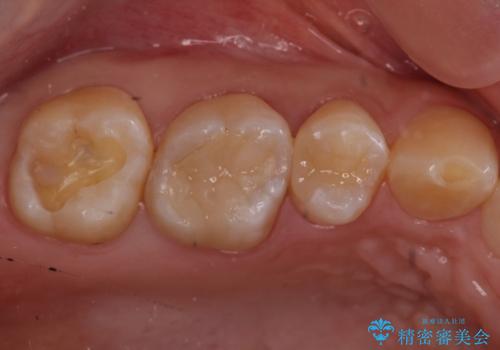 銀歯を白くしたいの治療中