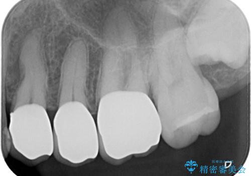 【オールセラミッククラウン】銀歯の下に大きな虫歯の治療後