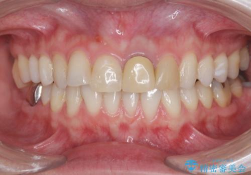 前歯の見た目を改善 セラミック審美治療の治療前