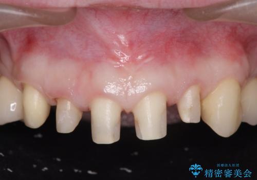 多発した前歯の重度虫歯治療の治療中